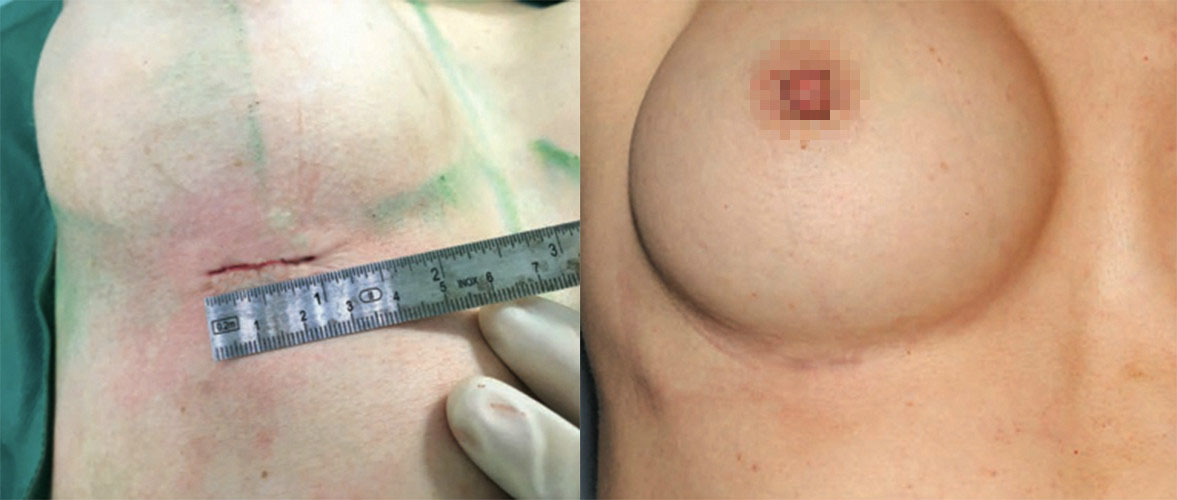 使用魔滴隆乳，可以有效所小傷口大小，這裡以胸下緣傷口為例，可以在2~2.5公分