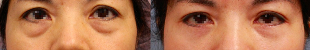 以前眼袋開刀常常忽略脂肪填補的重要性，手術後雖然改善，但仍然留下部分凹陷淚溝