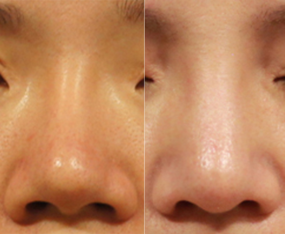 左邊：矽膠隆鼻術後出現攣縮歪斜，鼻梁過細的問題。右邊：採用全gortex鼻模及結構式隆鼻重修。