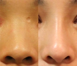 圖／使用卡麥拉鼻模：一般做出來的挺度比較明顯，有些人會覺得不夠自然，而且從鼻梁到鼻頭寬度的曲線不夠勻稱
