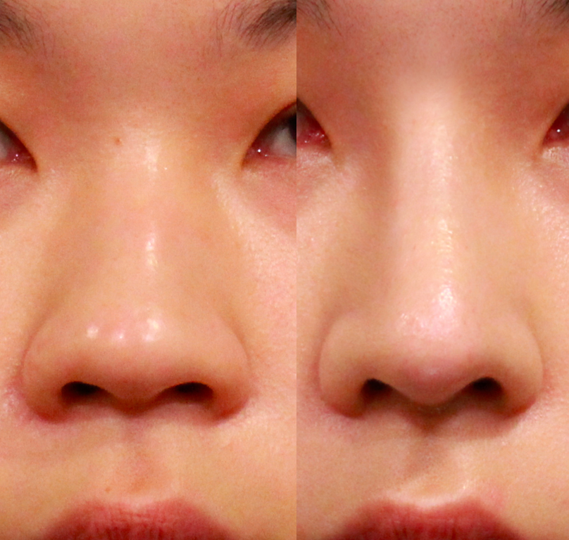 圖／透過異體真皮，改善鼻頭形狀與高度