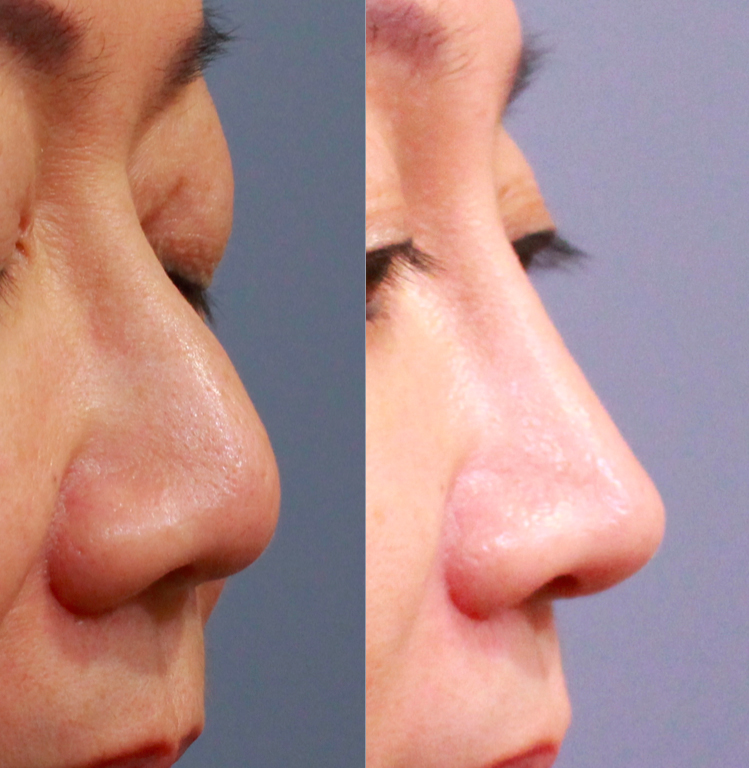 圖／透過異體真皮，改善鼻頭形狀與高度