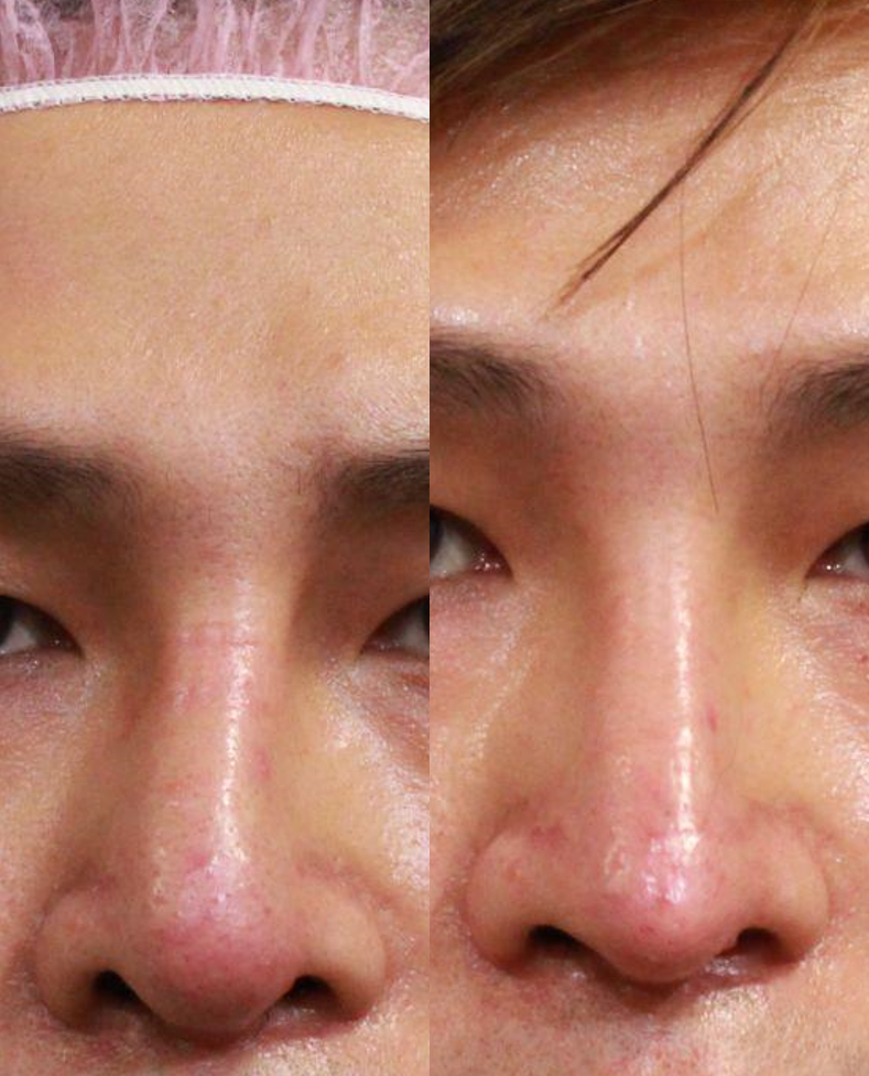 圖／異體肋骨隆鼻Before&After