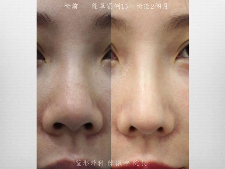 利用三段式結構式隆鼻，達到鼻頭延長、鼻珠呈現的效果