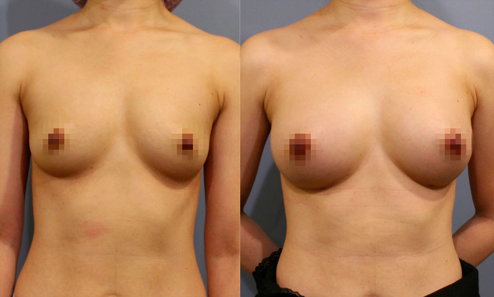 自體脂肪豐胸。左：術前；右：術後