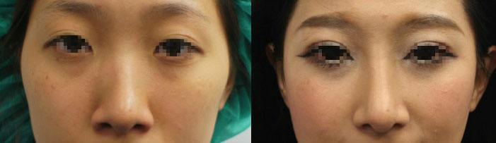 案例c，真實臨床上，同時接受隆鼻加上顴骨內推，左圖：術前；右圖：術後