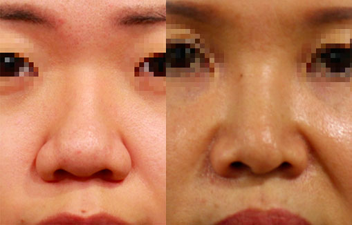 手術前的鼻子，連同鼻基底凹陷，更加重鼻頭鼻翼後縮的問題