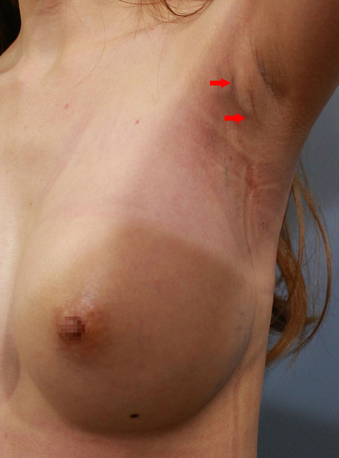 經腋下Motiva魔滴隆乳，手術後3周，傷口可以完全縮短在皺摺和手臂姿勢覆蓋處
