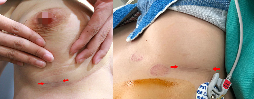 左：經胸下Motiva魔滴隆乳；右：經胸下水滴型果凍隆乳。比較之下明顯Motiva魔滴可以縮短手術傷口